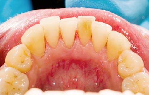 جرم و پلاک دندان