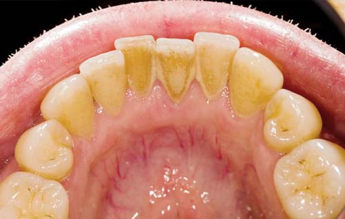 جرم و پلاک دندان