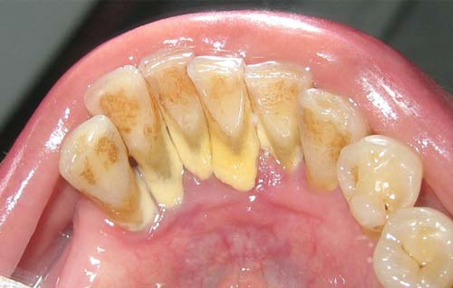 جرم و پلاک دندان