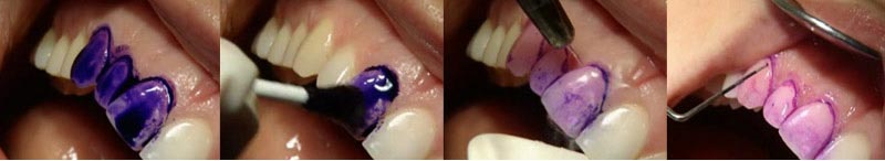 قرص های دیسکلوزینگ نمایان کننده جرم دندان